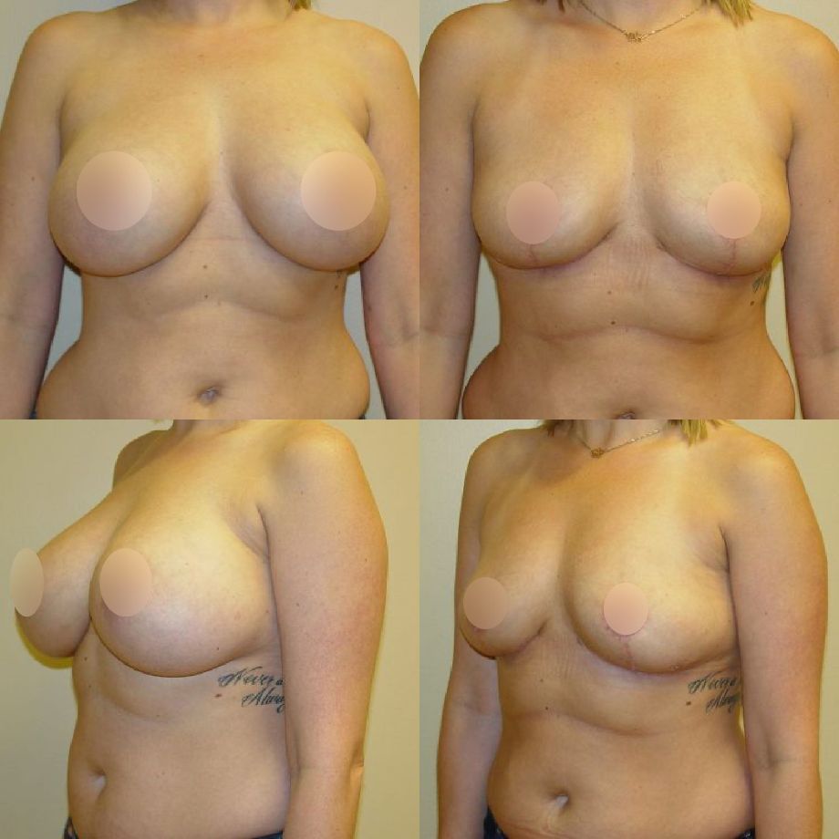 Breast Implant Removal in Chicago, IL