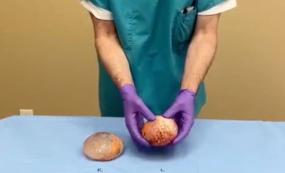 Dr. Straka holding an implant after breast implant removal