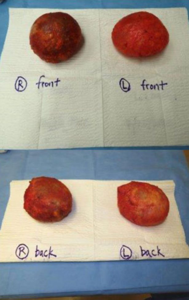 implants after breast implant removal